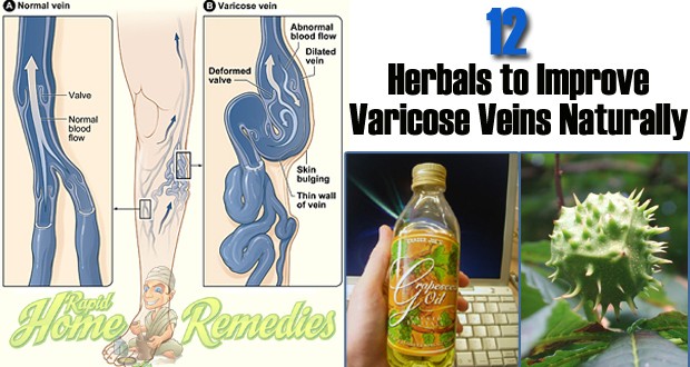 Home How To Get Rid Of Varicose Veins